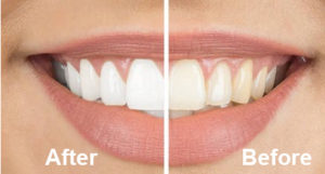 Healthy smile after Cosmetic Dentist Replaces Teeth Cosmetic Dentistry in Raleigh - before and after