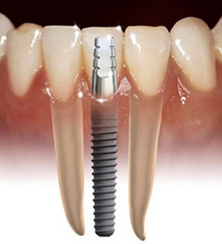 Restorative Dentistry with Implants