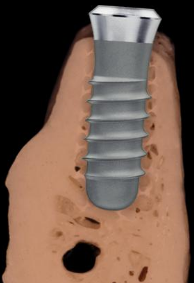 Dental Implant in Jawbone dental implant cross section in bone