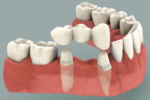 Dental Bridges Raleigh NC Dental Bridges Raleigh NC - Gover and Gover Dentistry
