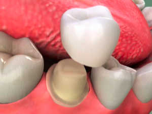 Dental Crowns Raleigh NC dental crowns raleigh nc - gover and gover dentistry