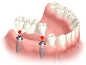 Implant Supported Bridge Implant Supported Bridge Raleigh NC - Gover and Gover Dentistry