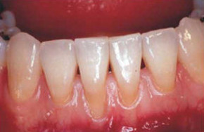 Receding Gums - Causes, Risks and Treatment