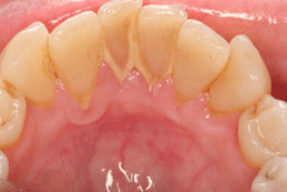 Tartar Buildup on Teeth Tartar Buildup on Teeth